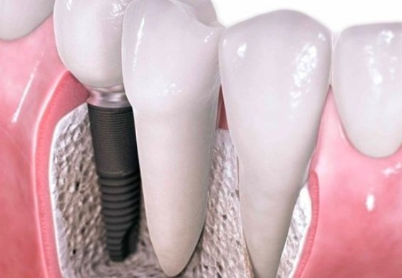 换一颗牙齿要多少钱