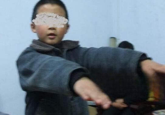 重庆僵尸男孩康复了吗 发病时像僵尸一样令人恐惧