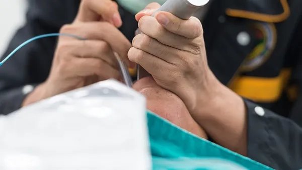 龋齿的有效治疗方法