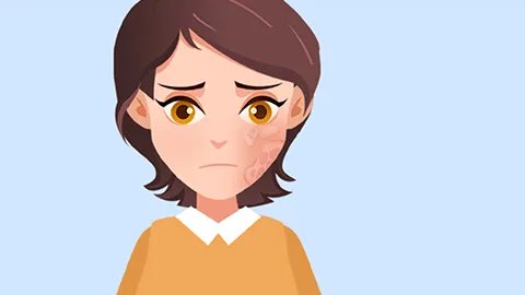 激光祛黄褐斑有效吗