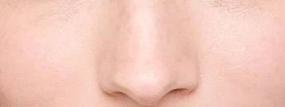 鼻翼缩小手术有什么后遗症