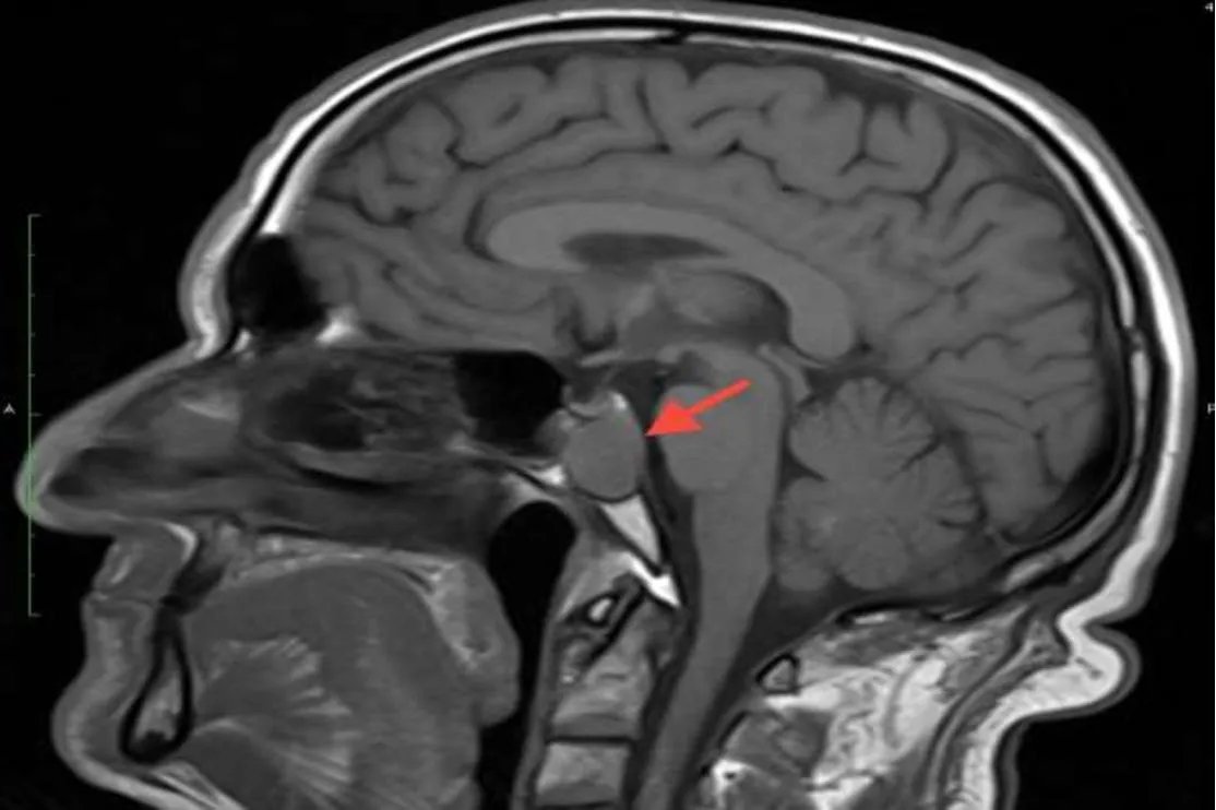 蝶骨在脑中的位置图片