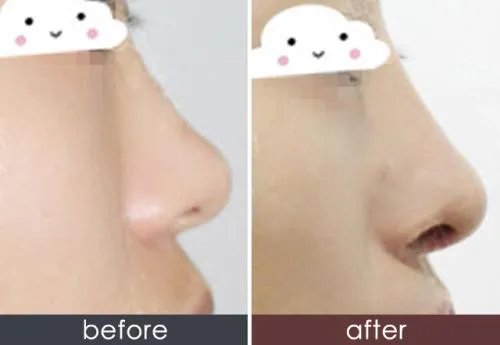 北京膨体韩式隆鼻美容整形医院有哪些名单_口碑哪里好点击一览