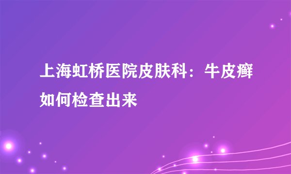 上海虹桥医院皮肤科:牛皮癣如何检查出来