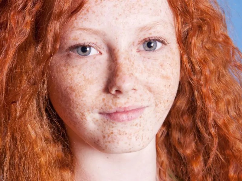 眼角长斑是怎么回事