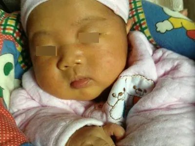 维生素E缺乏症全身皮肤发黄图片