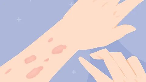 拔火罐的副作用