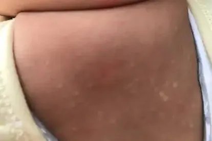 小孩后背有白斑图片