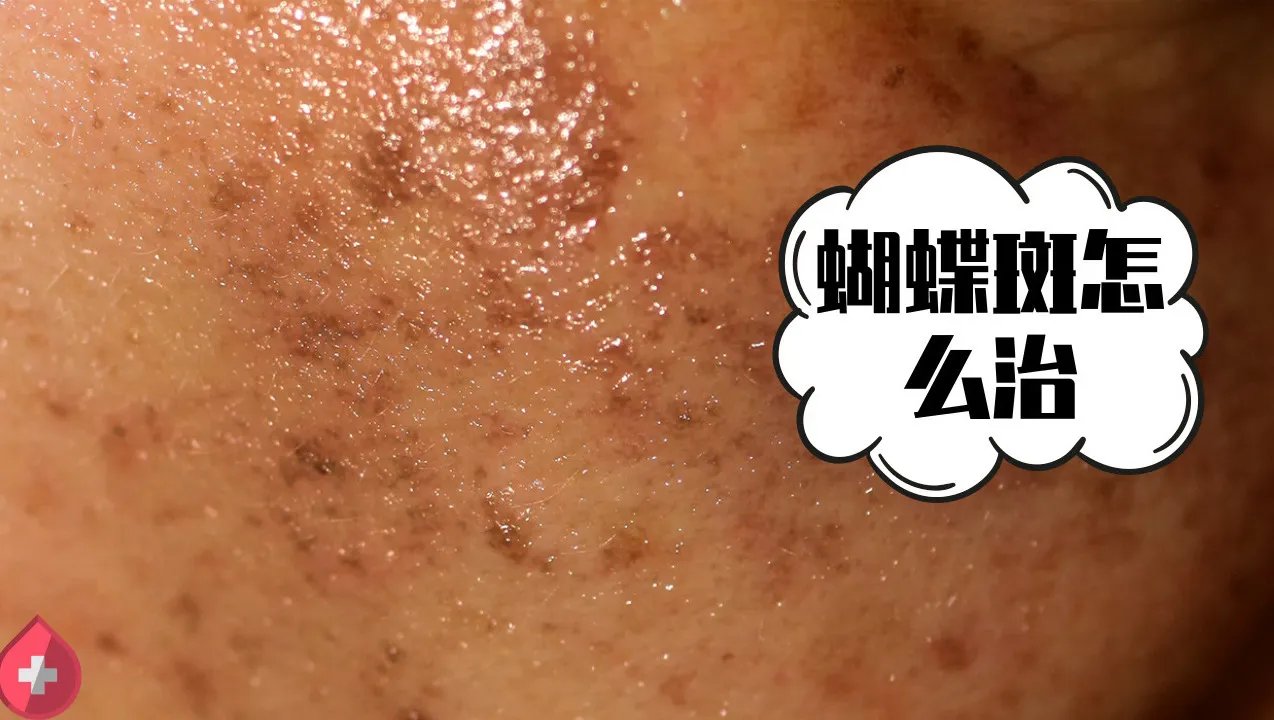 蝴蝶斑怎么治