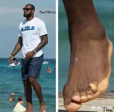 詹姆斯六个脚趾