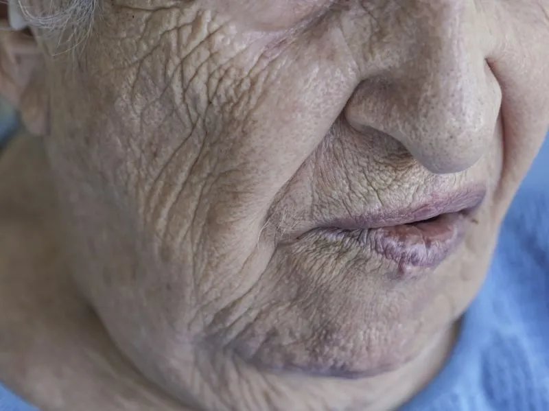 多大年龄长老年斑