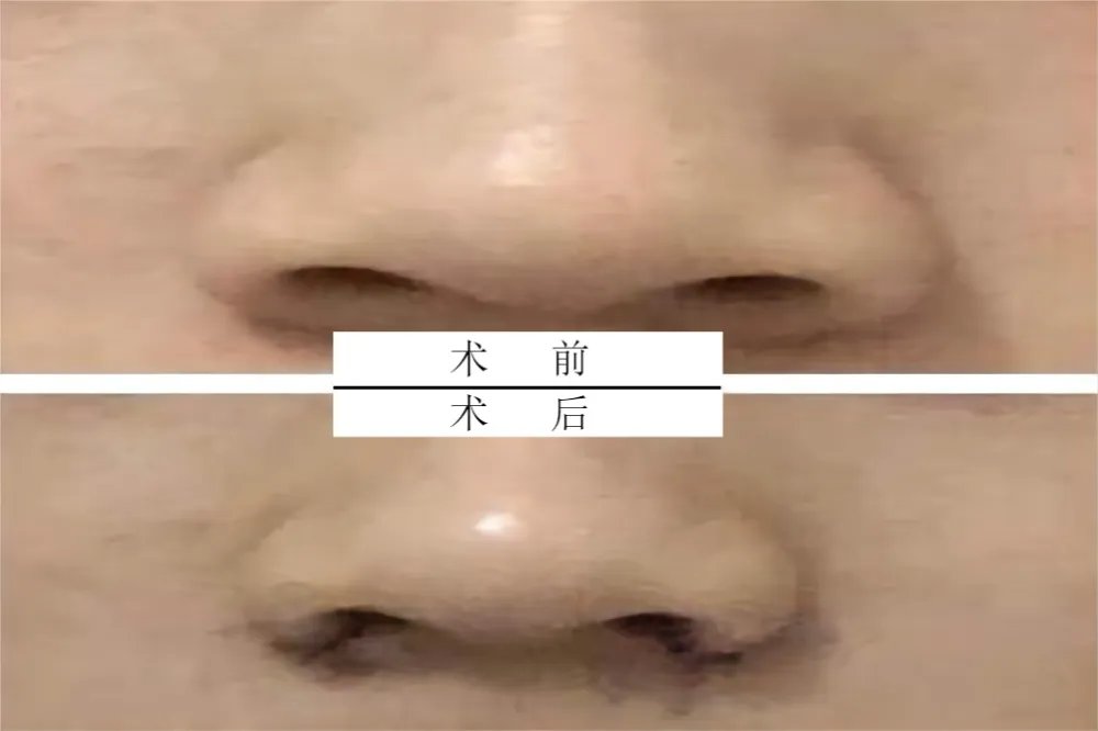 鼻翼缩小术对比照片