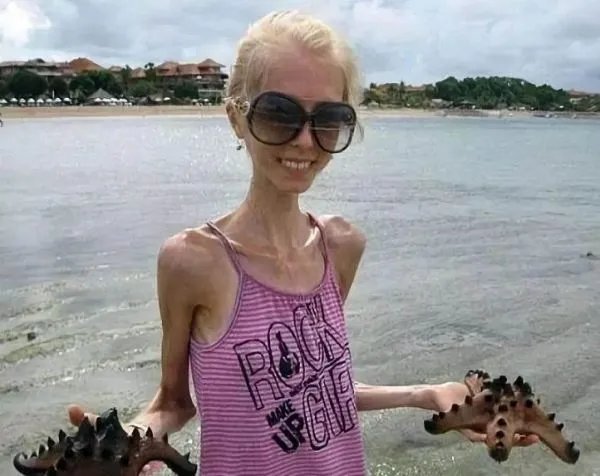 张若昀瘦到青筋凸起，过于消瘦对身体有何危害？