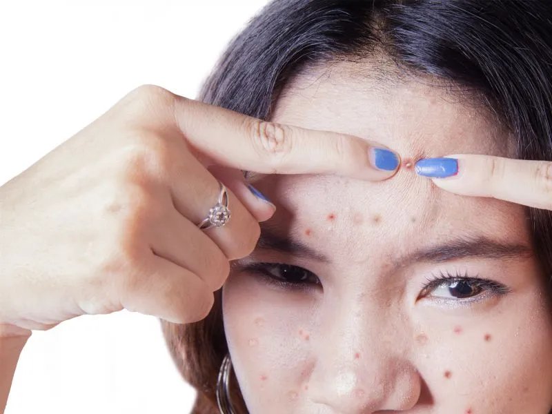 怎样治好青春痘