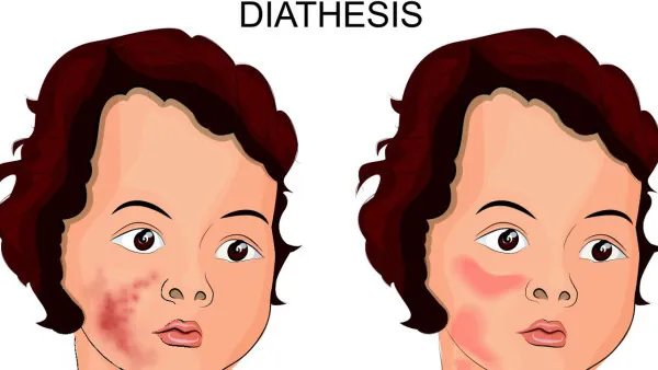 结节性痤疮怎么治疗