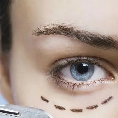 激光除皱方法怎么样