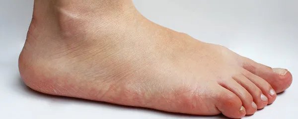 扁平足的矫正方法