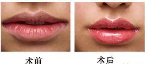 丰唇手术多少钱