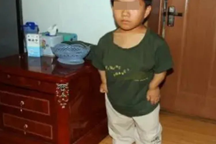 矮小症图片