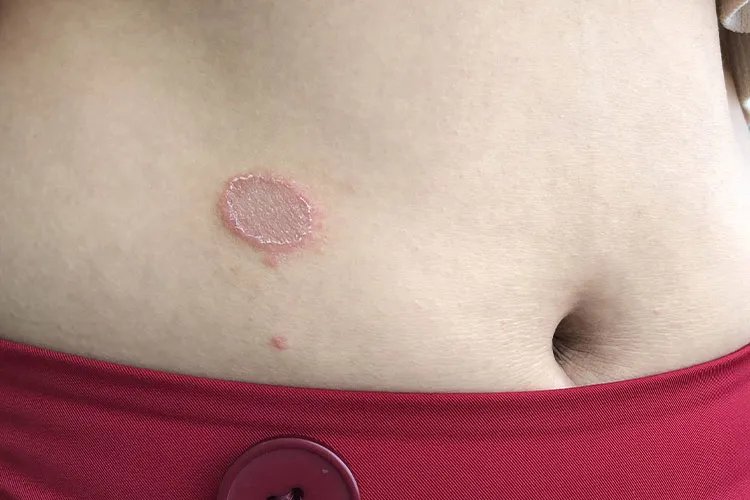 身上长了一些像癣一样的皮肤图片