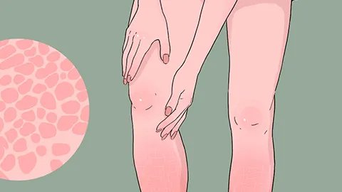 小腿皮肤像鱼鳞怎么治疗