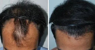 广州植发技术多少钱