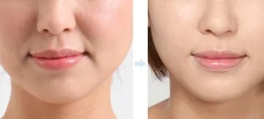 整形法令纹怎么样