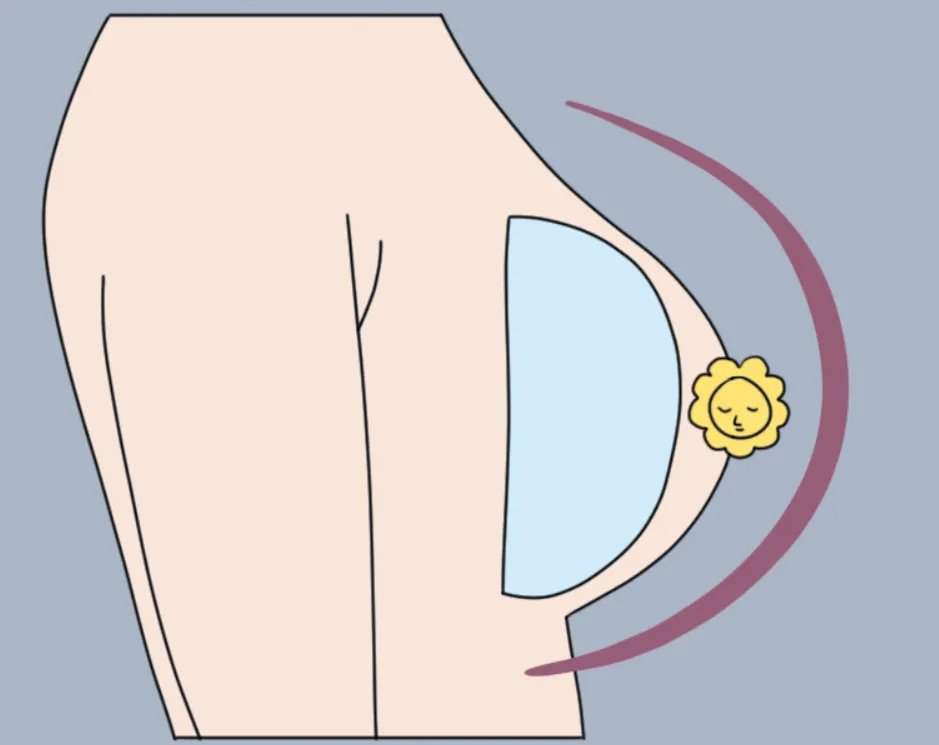 圆形假体隆胸术后图片