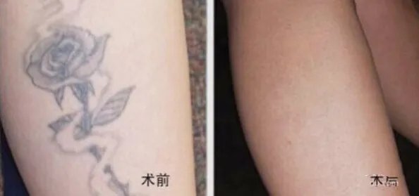 2021兰州时光激光整形美容医院洗纹身价格表(价目表)怎么样?