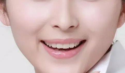 打玻尿酸隆鼻效果好吗