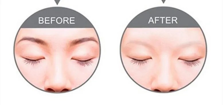 洗眉需要多少钱