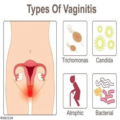 细菌性阴道炎怎样恢复