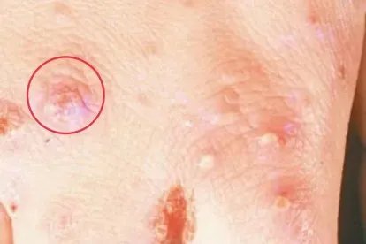 疥疮结节是什么样子的