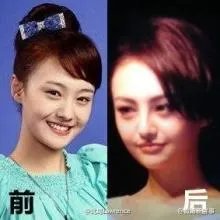 你们觉得郑爽整容前漂亮还是整容后漂亮？