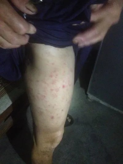 两腿之间长湿疹的症状