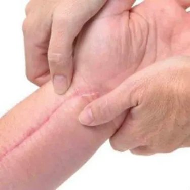 怎么修复凹陷疤痕