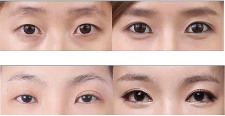 开眼角眼睛会变大吗
