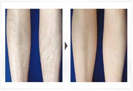 上海激光脱毛的效果怎么样