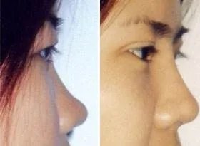 鼻子整形前后对比图