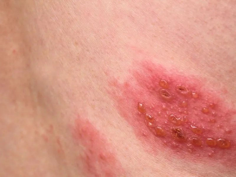 过敏性药疹的治疗