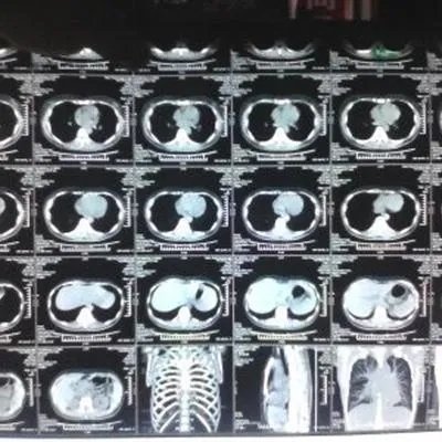 婴儿吃奶咳嗽怎么回事?