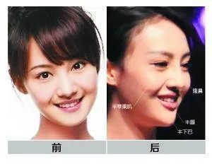 你们觉得郑爽整容前漂亮还是整容后漂亮？