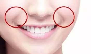 整形法令纹怎么样