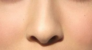 玻尿酸隆鼻怎么样