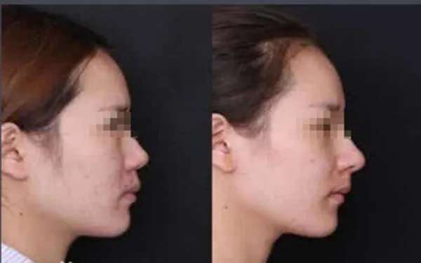 北京好的肋软骨隆鼻整形医院在哪