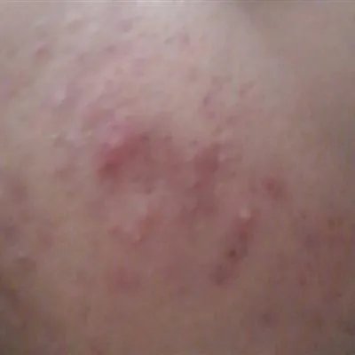 怎么快速去痘痘