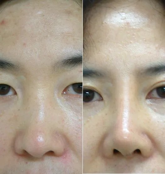 北京鼻子整形的费用