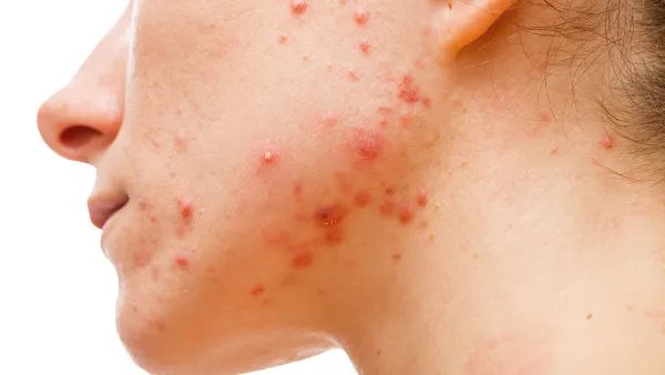 扁平疣不能吃什么