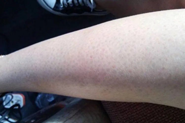 毛囊性鱼鳞病小腿斑图片