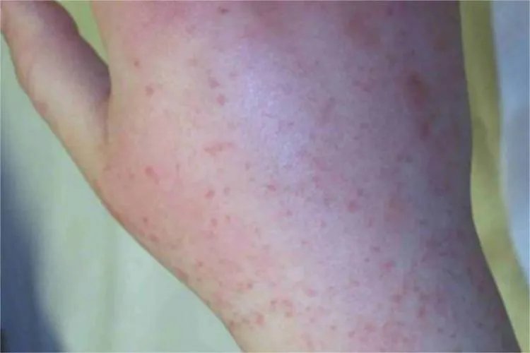 风疹红点图片